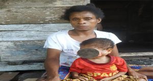 Makin Prihatin Anak Penderitaan Tumor Di Waropen