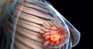 Sadari Benjolan Di Payudara, Apakah Berbahaya?